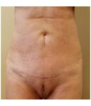 Pubic area after pubic lift, front view — Dr. Rudderman, Atlanta.