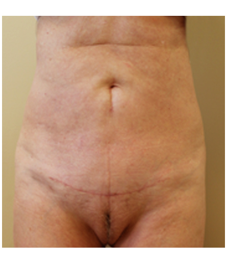 Pubic area after pubic lift, front view — Dr. Rudderman, Atlanta.