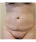 Pubic area before pubic lift, front view — Dr. Rudderman, Atlanta.