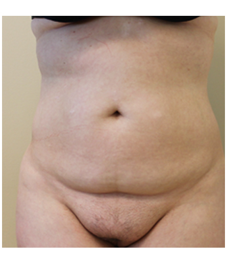 Pubic area before pubic lift, front view — Dr. Rudderman, Atlanta.