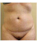 Pubic area before pubic lift, front view — Dr. Rudderman, Atlanta.