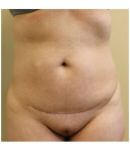 Pubic area before pubic lift, front view — Dr. Rudderman, Atlanta.