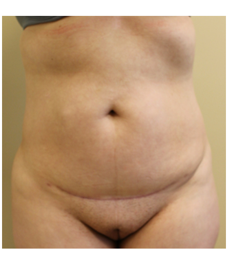 Pubic area before pubic lift, front view — Dr. Rudderman, Atlanta.