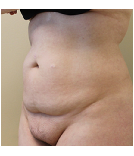 Pubic area before pubic lift, side profile view — Dr. Rudderman, Atlanta.