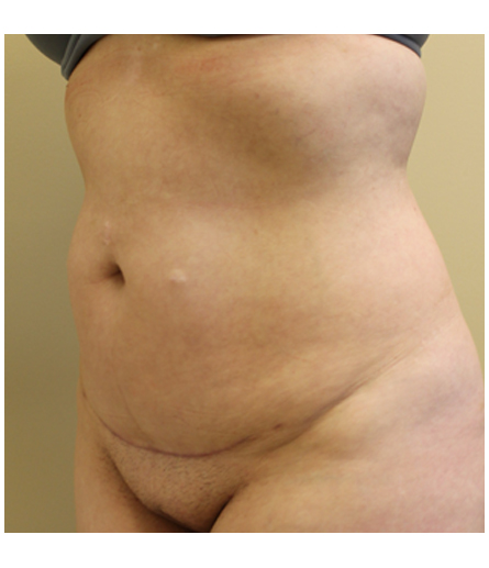 Pubic area before pubic lift, three-quarter view — Dr. Rudderman, Atlanta.