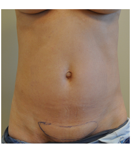 Pubic area with pre-surgical markings before pubic lift, front view — Dr. Rudderman, Atlanta.