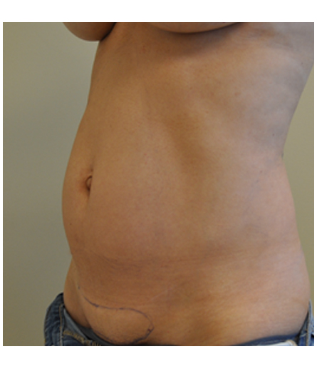 Pubic area with pre-surgical markings before pubic lift, side profile view — Dr. Rudderman, Atlanta.