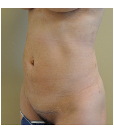 Pubic area after pubic lift, three-quarter view — Dr. Rudderman, Atlanta.