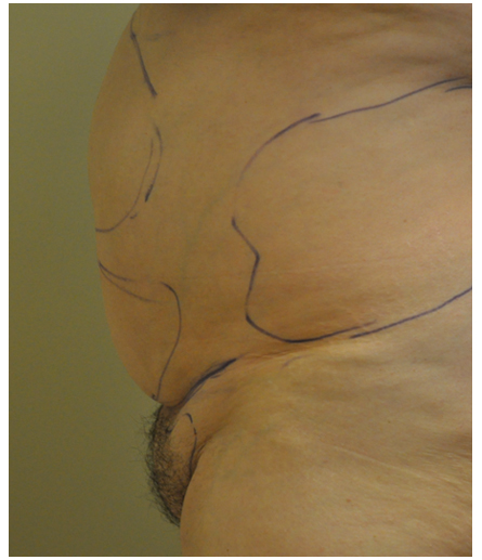Pubic area with pre-surgical markings before pubic lift, side profile view — Dr. Rudderman, Atlanta.