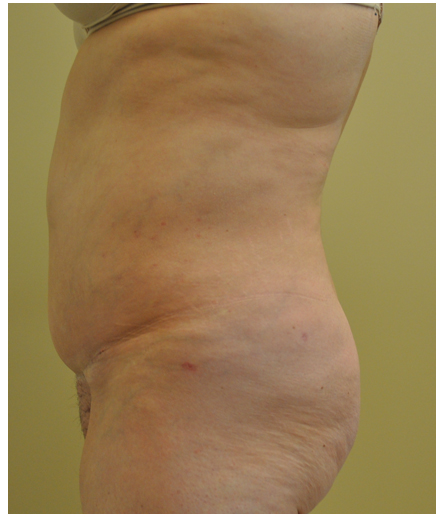Pubic area before pubic lift, side profile view — Dr. Rudderman, Atlanta.