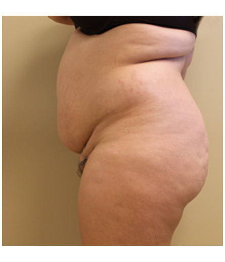 Pubic area before pubic lift, side profile view — Dr. Rudderman, Atlanta.