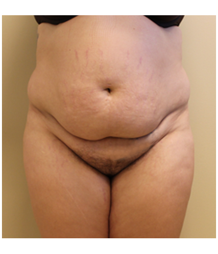 Pubic area before pubic lift, front view — Dr. Rudderman, Atlanta.