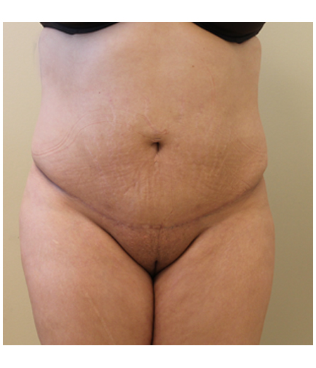Pubic area after pubic lift, front view — Dr. Rudderman, Atlanta.