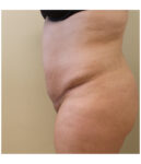 Pubic area before pubic lift, side profile view — Dr. Rudderman, Atlanta.