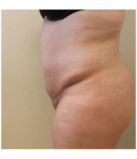 Pubic area before pubic lift, side profile view — Dr. Rudderman, Atlanta.