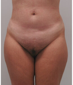 Pubic area after pubic lift, front view — Dr. Rudderman, Atlanta.
