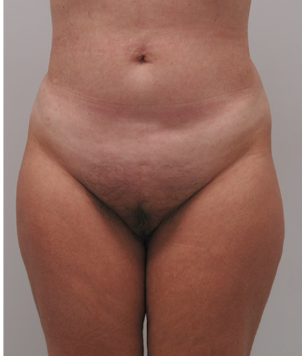 Pubic area after pubic lift, front view — Dr. Rudderman, Atlanta.