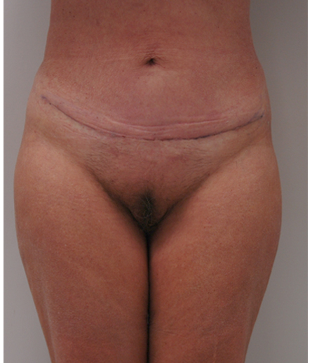 Pubic area after pubic lift, front view — Dr. Rudderman, Atlanta.