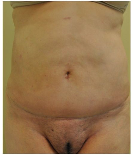 Pubic area before pubic lift, front view — Dr. Rudderman, Atlanta.