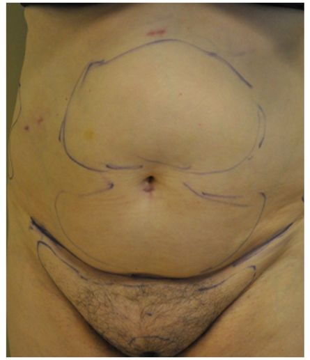 Pubic area with pre-surgical markings before pubic lift, front view — Dr. Rudderman, Atlanta.