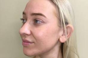 Face after BBL photofacial, three-quarter view — Dr. Rudderman, Atlanta.