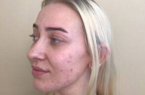 Face before BBL photofacial, three-quarter view — Dr. Rudderman, Atlanta.