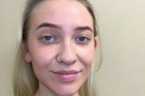 Face after BBL photofacial, front view — Dr. Rudderman, Atlanta.
