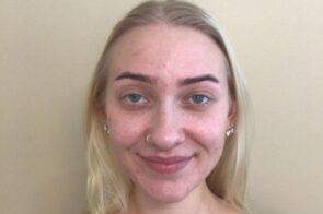 Face before BBL photofacial, front view — Dr. Rudderman, Atlanta.