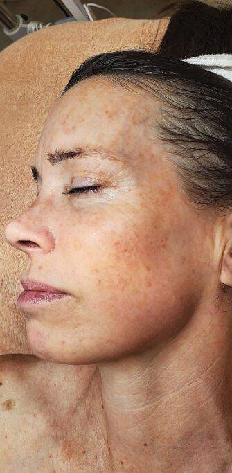 Face before BBL photofacial, three-quarter view — Dr. Rudderman, Atlanta.