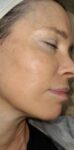 Face after BBL photofacial, three-quarter view — Dr. Rudderman, Atlanta.