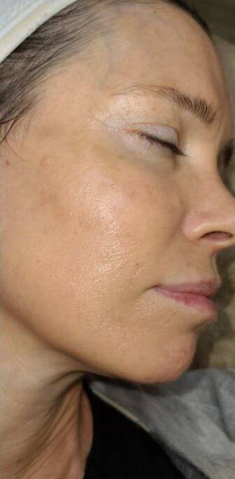 Face after BBL photofacial, three-quarter view — Dr. Rudderman, Atlanta.