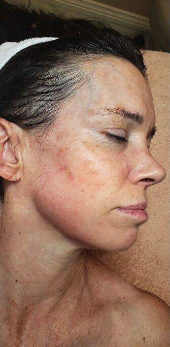 Face before BBL photofacial, three-quarter view — Dr. Rudderman, Atlanta.