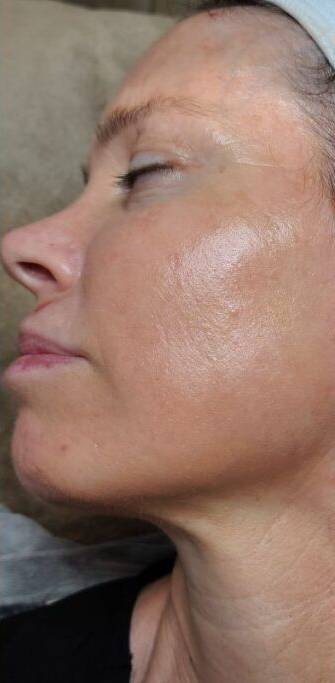 Face after BBL photofacial, side profile view — Dr. Rudderman, Atlanta.