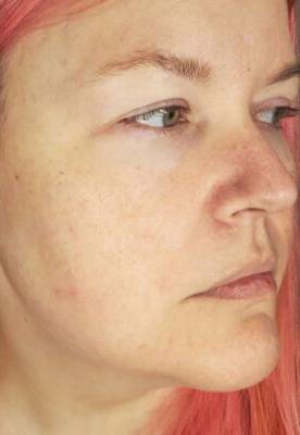 Face after BBL photofacial, three-quarter view — Dr. Rudderman, Atlanta.