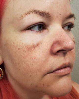 Face before BBL photofacial, three-quarter view — Dr. Rudderman, Atlanta.