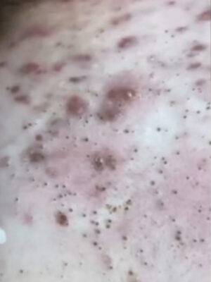 Skin before BBL photofacial, front view — Dr. Rudderman, Atlanta.