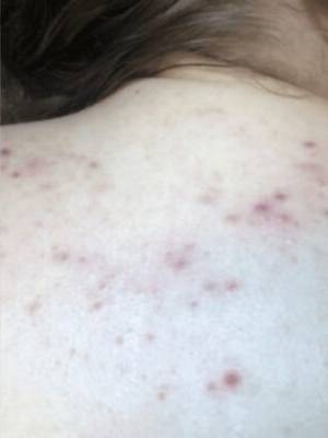 Back before BBL photofacial, back view — Dr. Rudderman, Atlanta.
