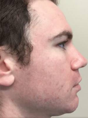 Face before BBL photofacial, side profile view — Dr. Rudderman, Atlanta.