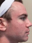 Face after BBL photofacial, side profile view — Dr. Rudderman, Atlanta.