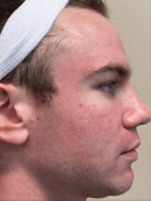 Face after BBL photofacial, side profile view — Dr. Rudderman, Atlanta.