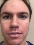 Face before BBL photofacial, front view — Dr. Rudderman, Atlanta.