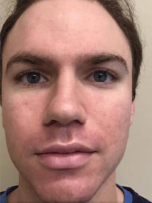 Face before BBL photofacial, front view — Dr. Rudderman, Atlanta.