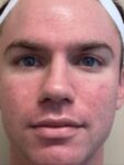 Face after BBL photofacial, front view — Dr. Rudderman, Atlanta.