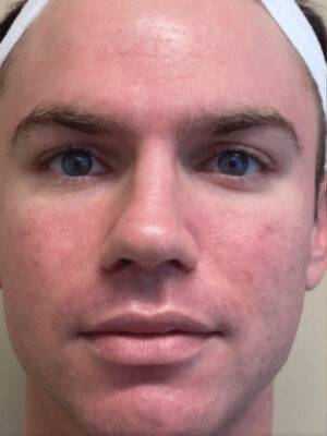Face after BBL photofacial, front view — Dr. Rudderman, Atlanta.