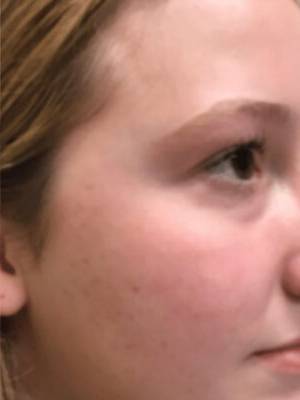 Cheek after BBL photofacial, three-quarter view — Dr. Rudderman, Atlanta.