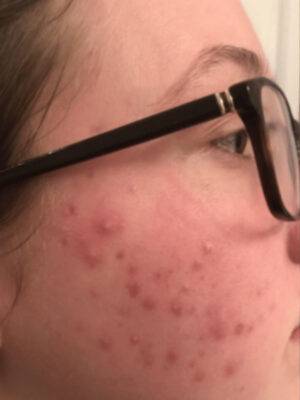 Cheek before BBL photofacial, three-quarter view — Dr. Rudderman, Atlanta.