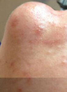 Facial or chemical peel patient photo, front view of the facial skin — Dr. Rudderman, Atlanta.