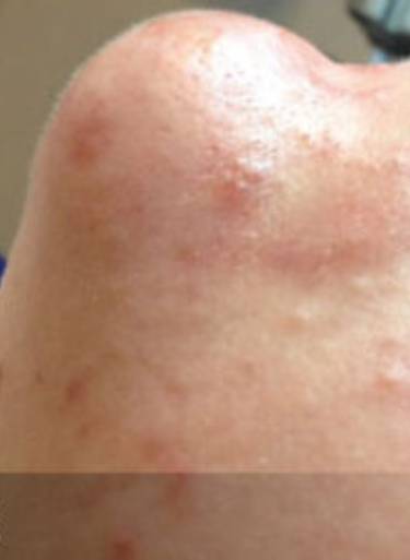 Facial or chemical peel patient photo, front view of the facial skin — Dr. Rudderman, Atlanta.
