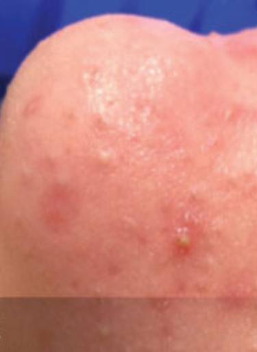 Facial or chemical peel patient photo, front view of the facial skin — Dr. Rudderman, Atlanta.