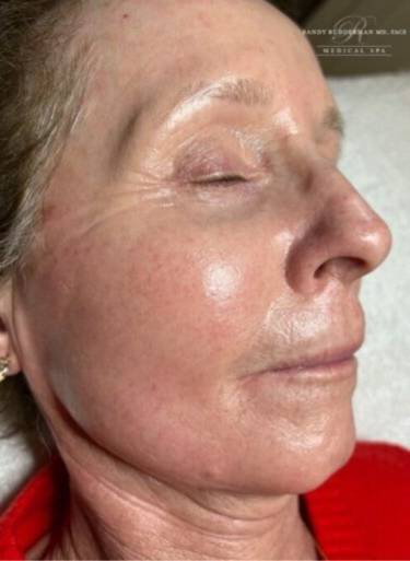 Facial or chemical peel patient photo, three-quarter view of the facial skin — Dr. Rudderman, Atlanta.